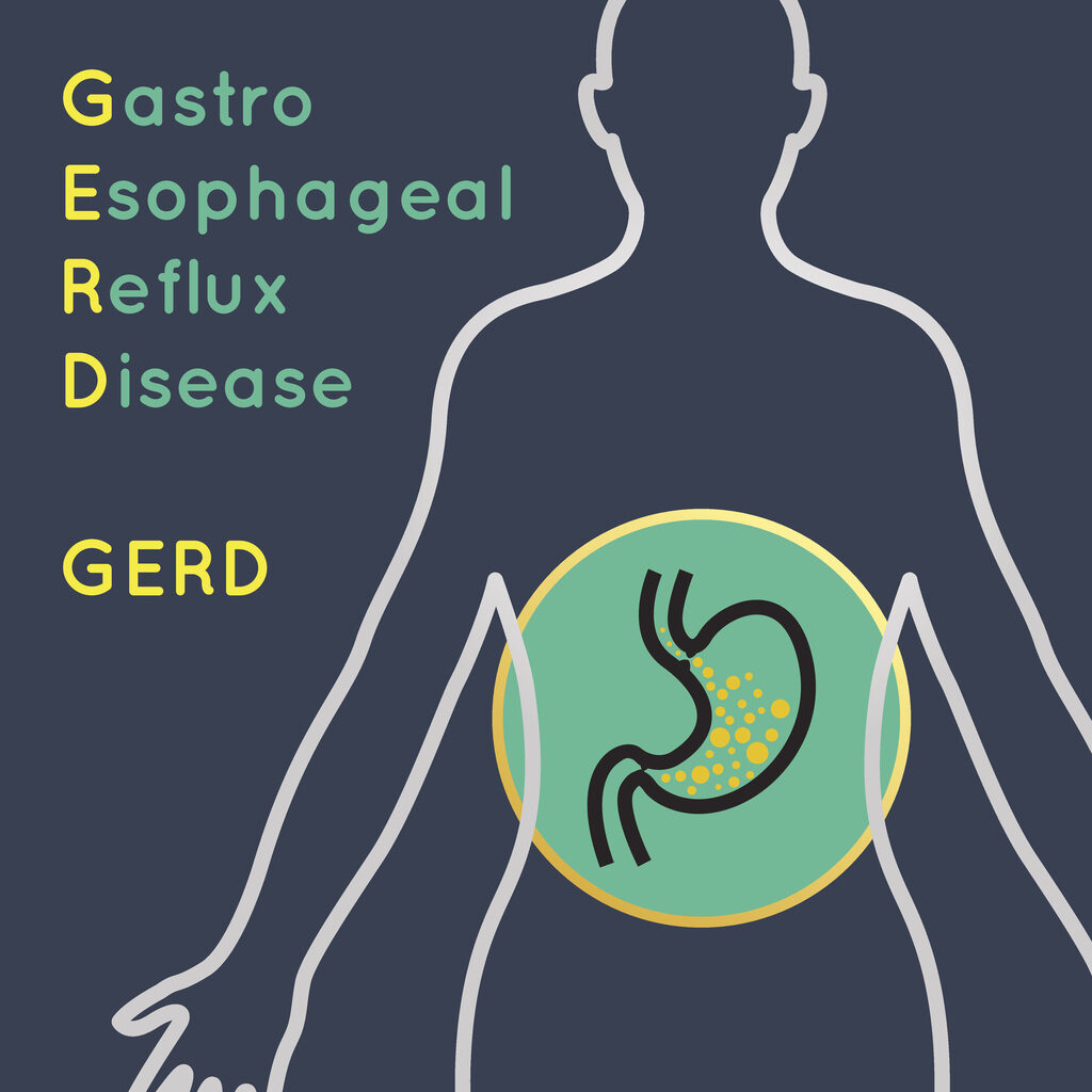 Gastro Esophageal Reflux Disease (GERD) illustration of human body with focus on the stomach